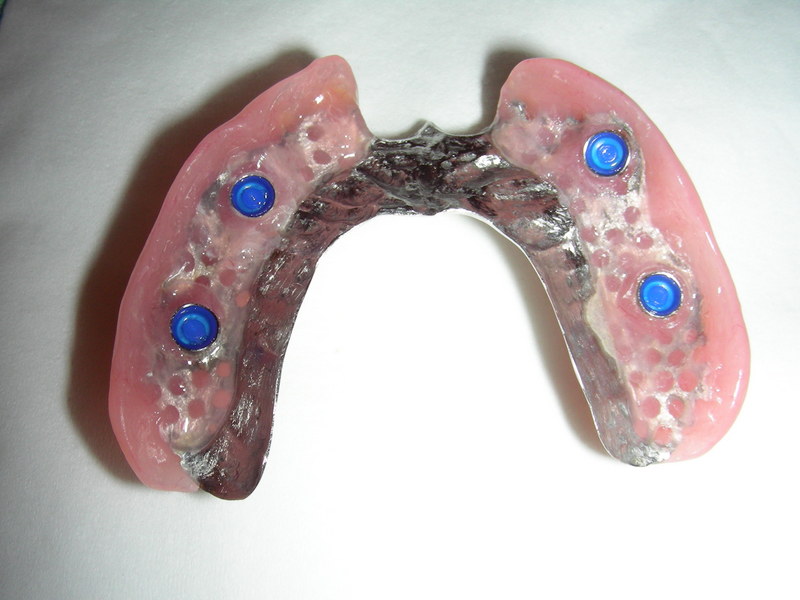 implantes irun 2