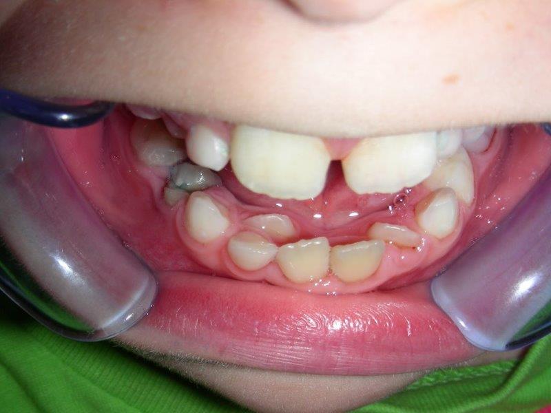 doble dentición