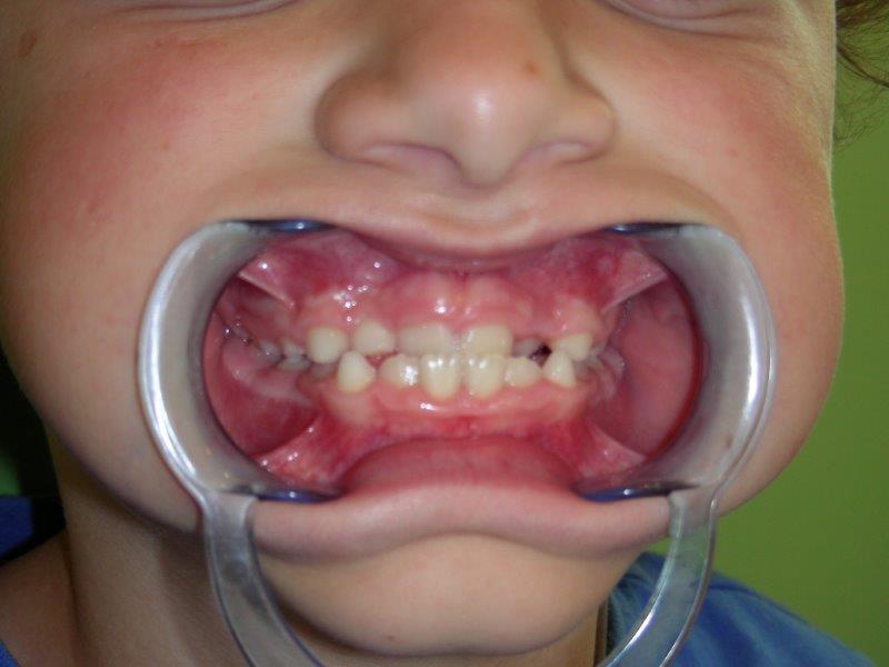 mordida cruzada dientes anteriores