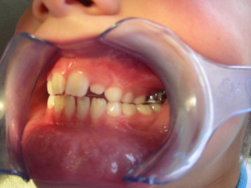 mordida cruzada dientes posteriores