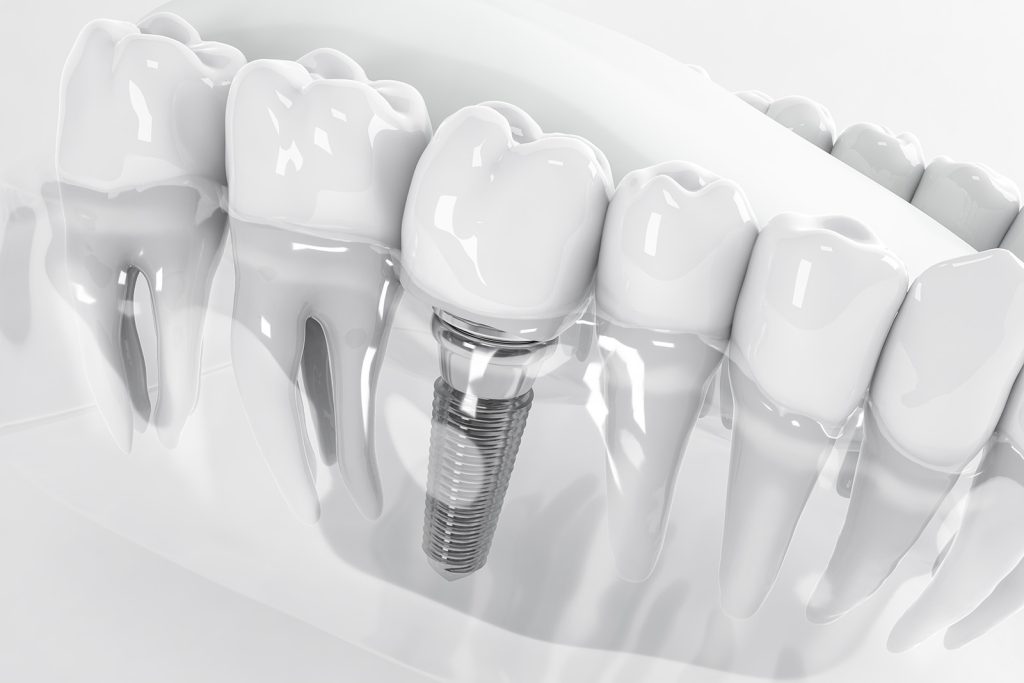Illustration en trois dimensions d’un implant dentaire et de sa couronne